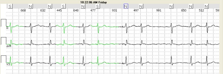 afib